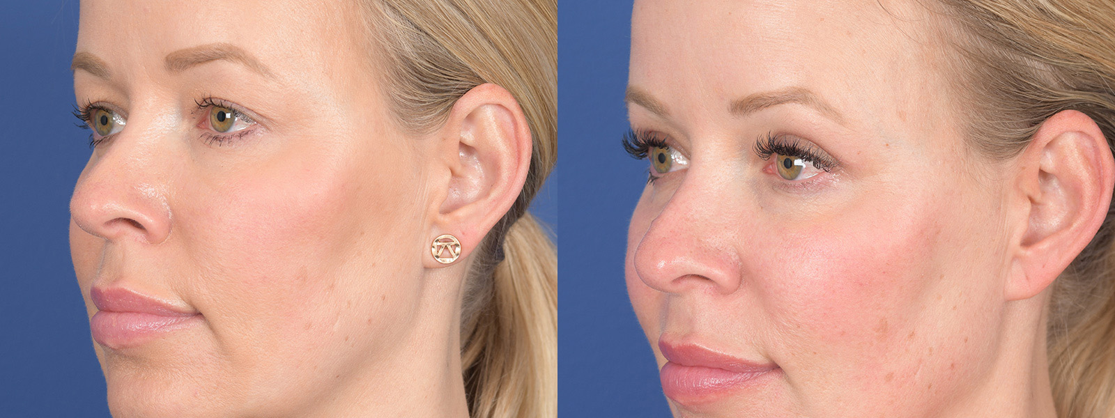 Blepharoplasty Before and After | Weber Facial Plastic Surgery