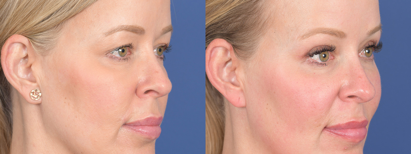 Blepharoplasty Before and After | Weber Facial Plastic Surgery
