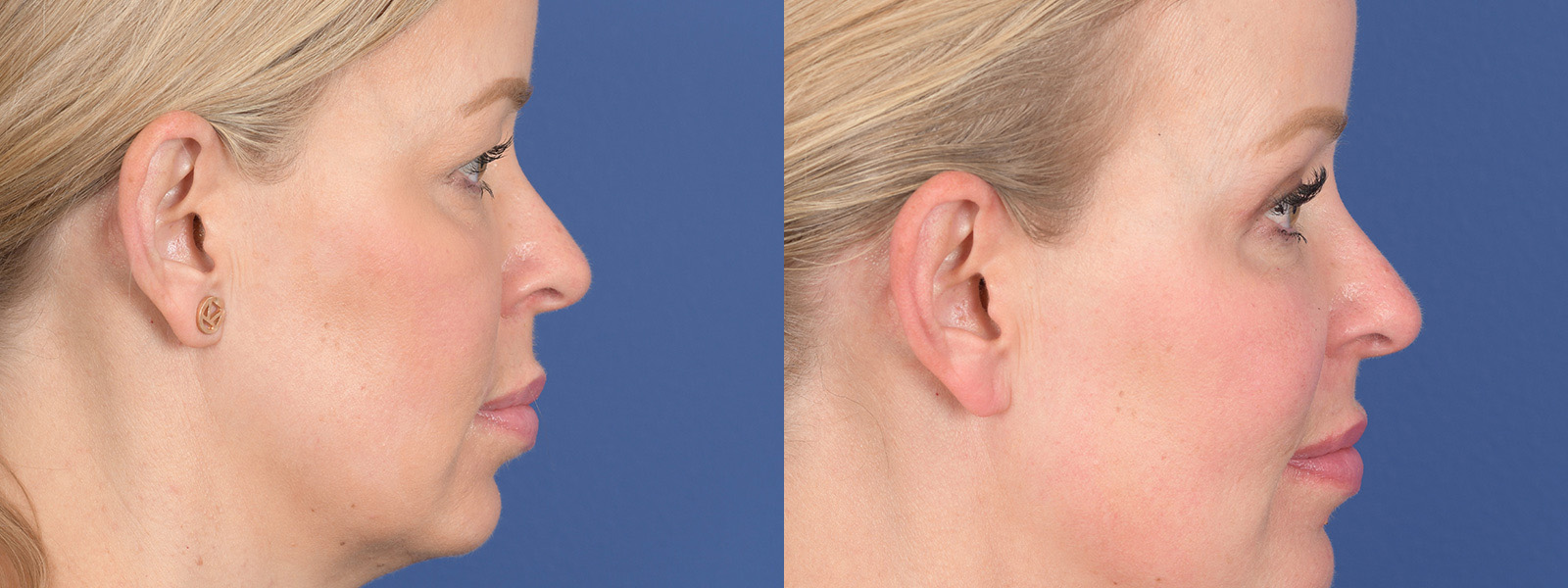 Blepharoplasty Before and After | Weber Facial Plastic Surgery