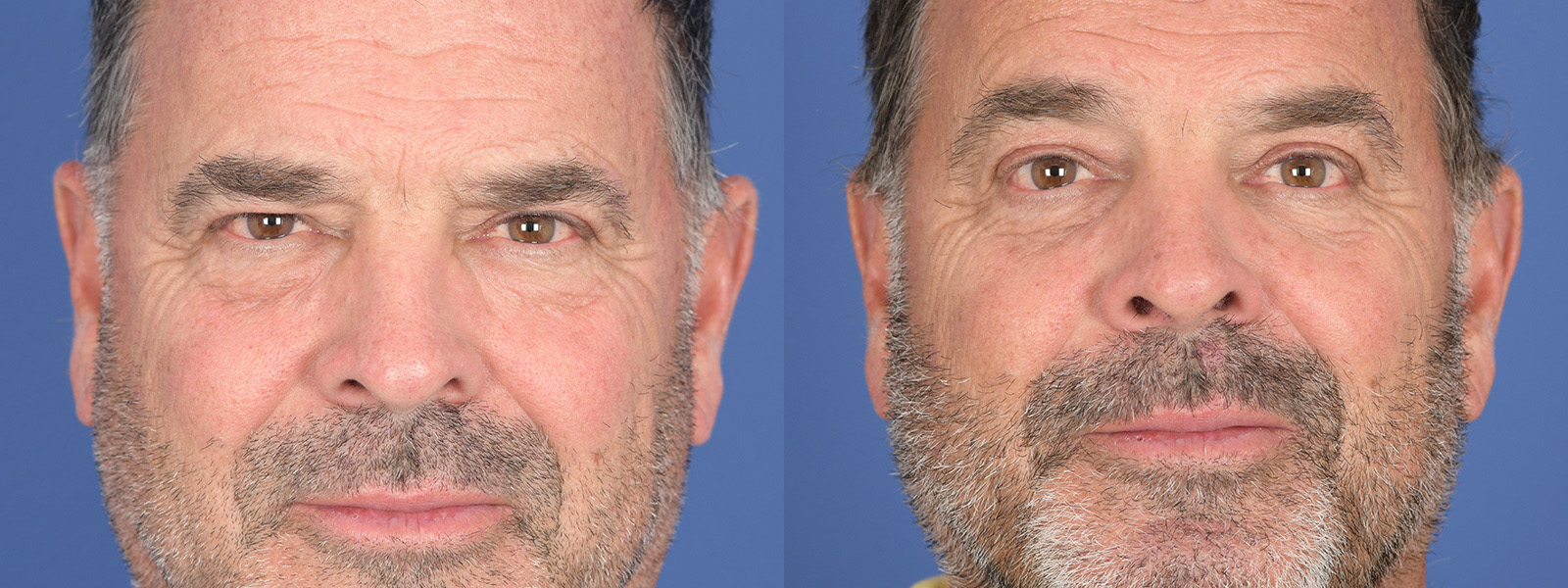 Blepharoplasty Before and After | Weber Facial Plastic Surgery