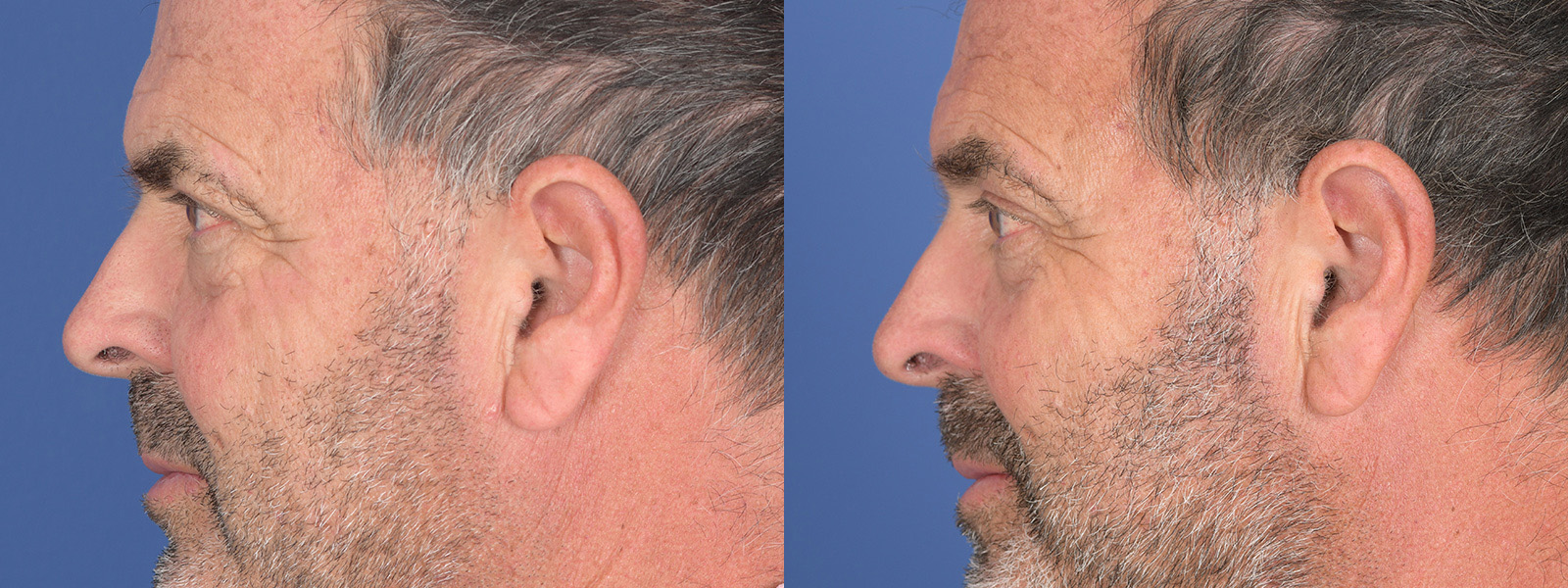 Blepharoplasty Before and After | Weber Facial Plastic Surgery