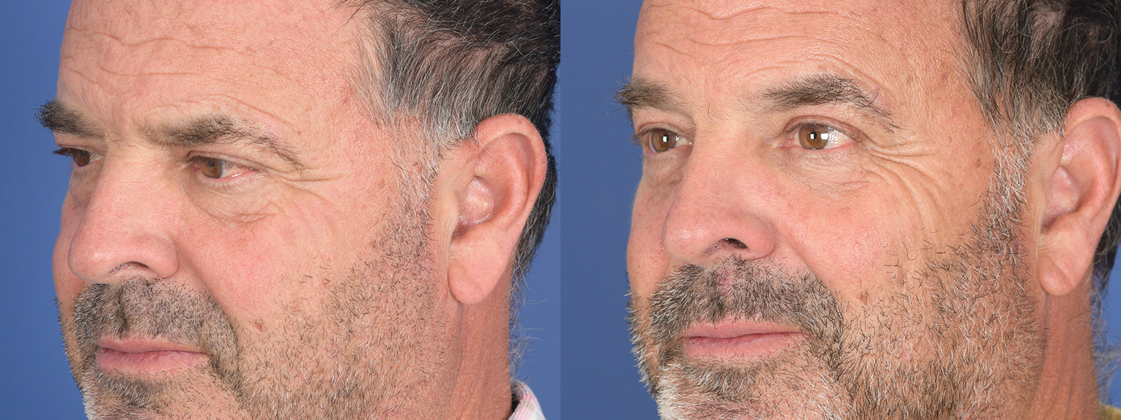 Blepharoplasty Before and After | Weber Facial Plastic Surgery