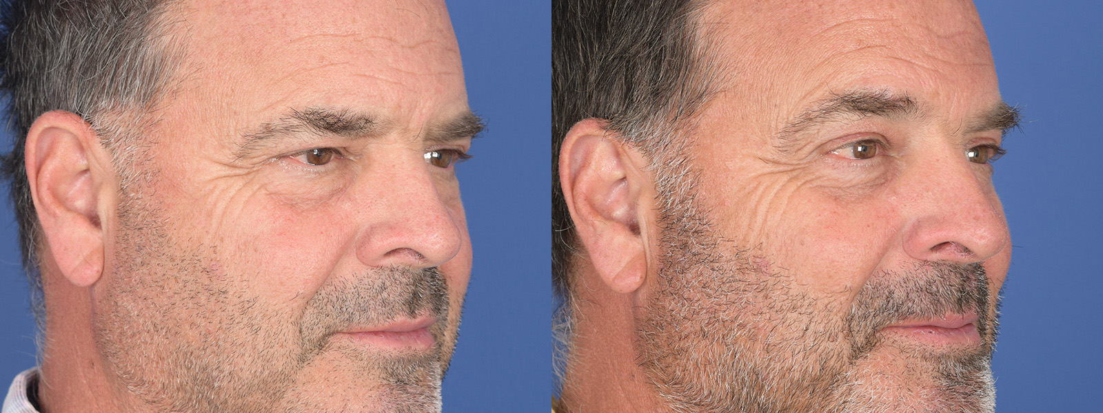 Blepharoplasty Before and After | Weber Facial Plastic Surgery