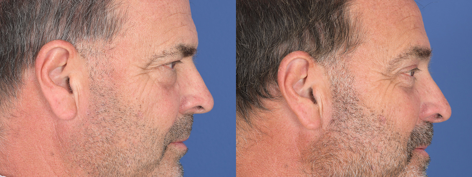 Blepharoplasty Before and After | Weber Facial Plastic Surgery