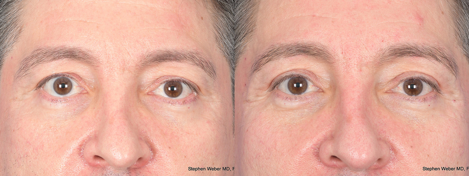 Blepharoplasty Before and After | Weber Facial Plastic Surgery