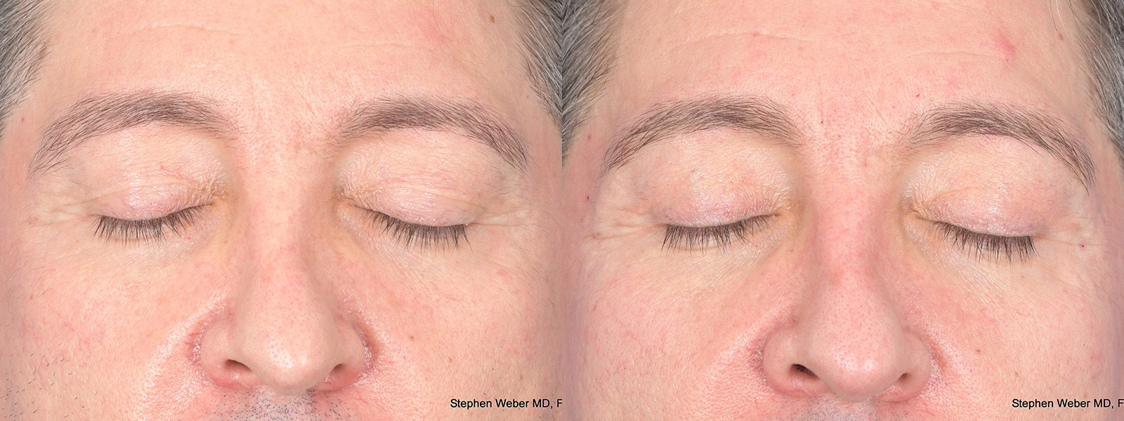 Blepharoplasty Before and After | Weber Facial Plastic Surgery