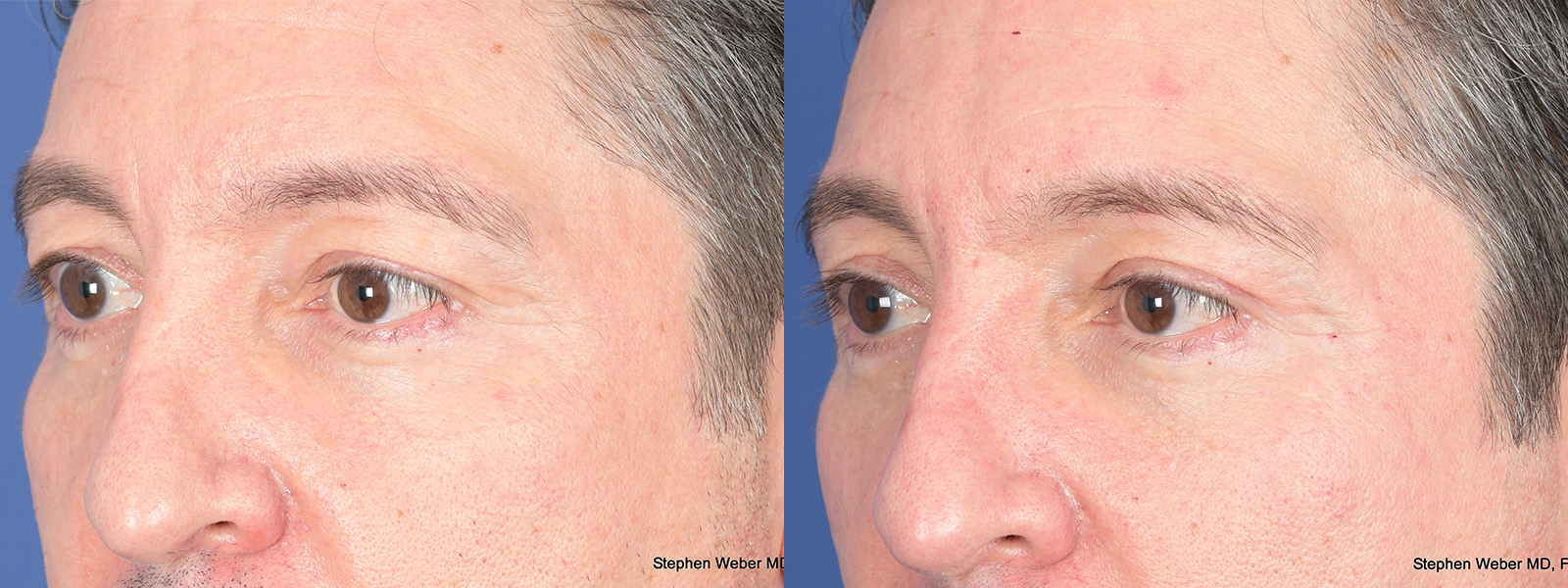 Blepharoplasty Before and After | Weber Facial Plastic Surgery