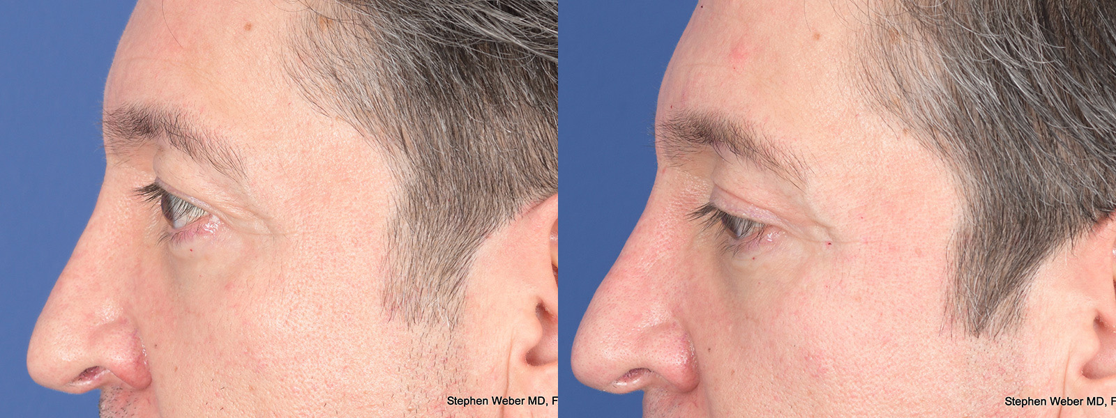 Blepharoplasty Before and After | Weber Facial Plastic Surgery