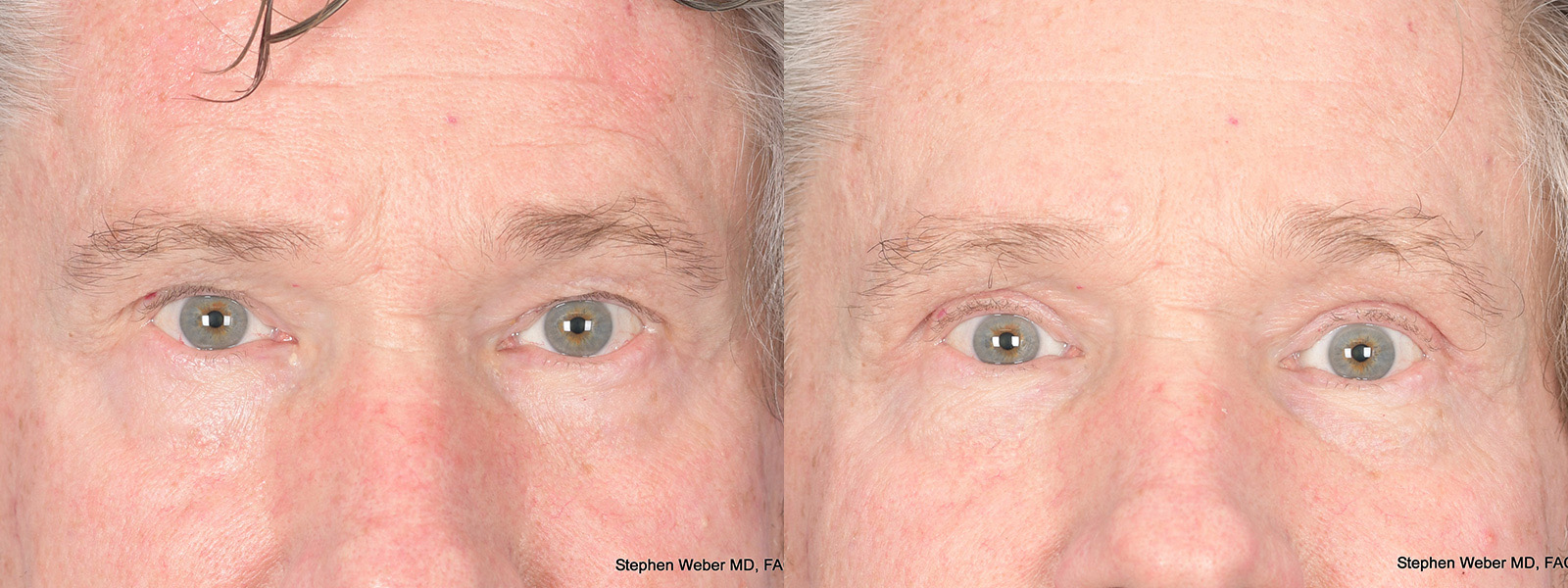 Blepharoplasty Before and After | Weber Facial Plastic Surgery