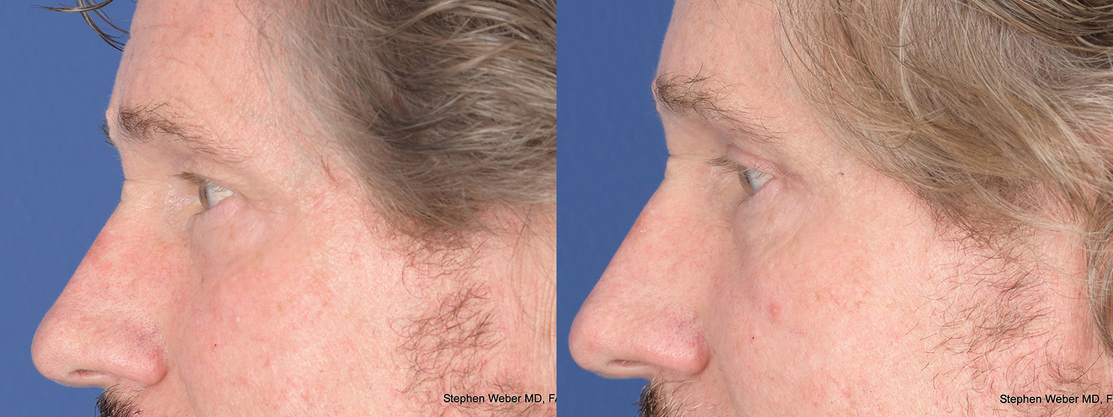 Blepharoplasty Before and After | Weber Facial Plastic Surgery