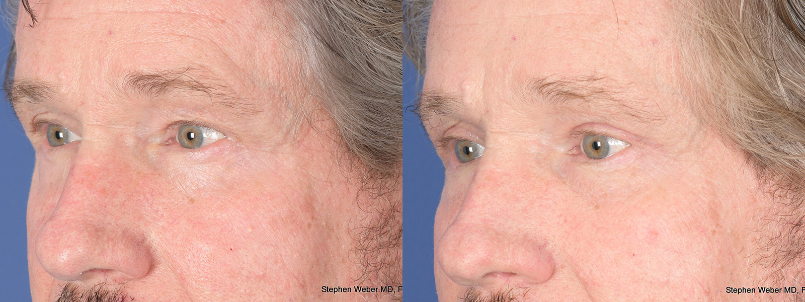 Blepharoplasty Before and After | Weber Facial Plastic Surgery