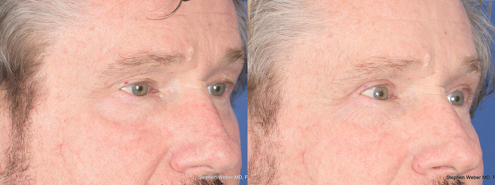Blepharoplasty Before and After | Weber Facial Plastic Surgery