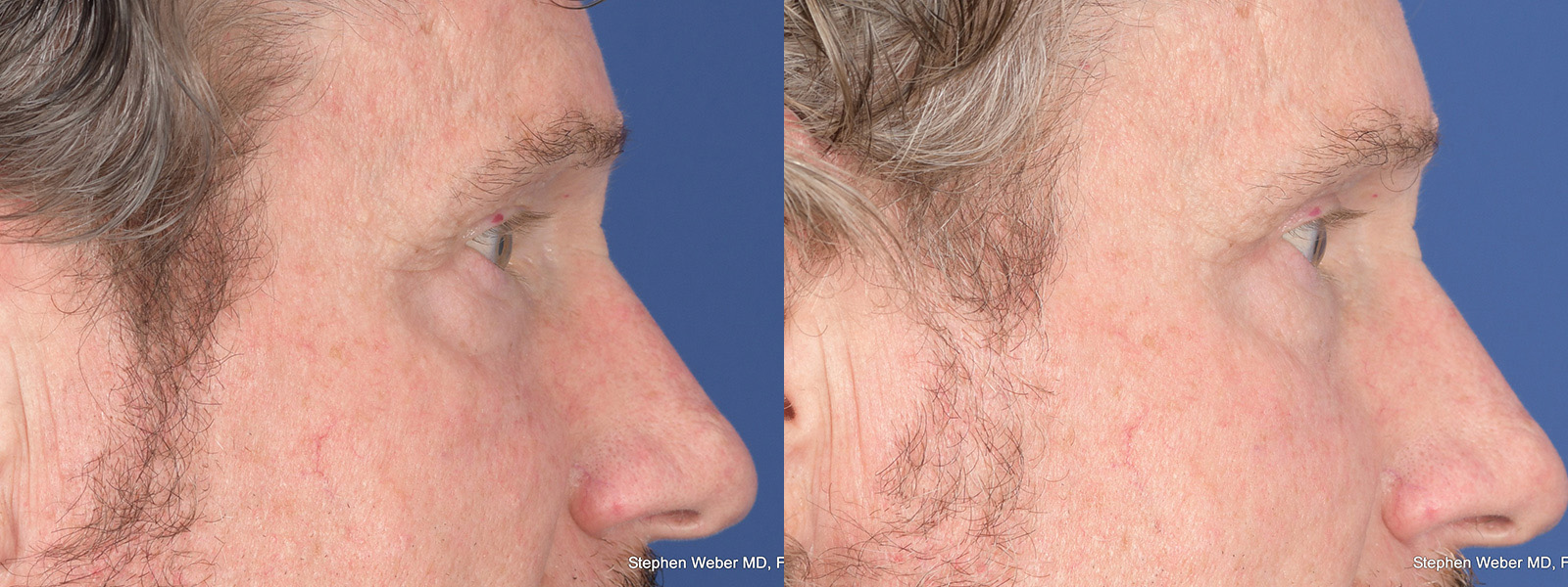 Blepharoplasty Before and After | Weber Facial Plastic Surgery