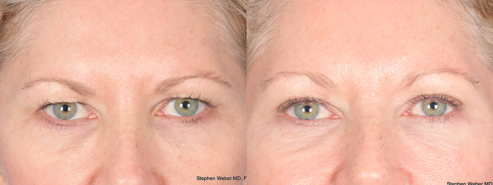 Blepharoplasty Before and After | Weber Facial Plastic Surgery