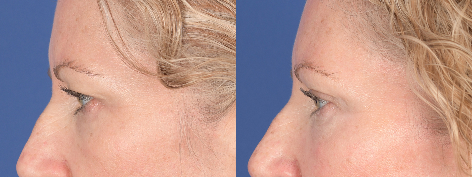 Blepharoplasty Before and After | Weber Facial Plastic Surgery