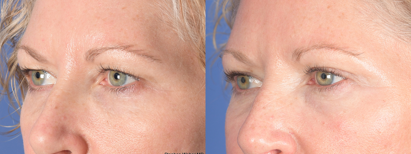 Blepharoplasty Before and After | Weber Facial Plastic Surgery
