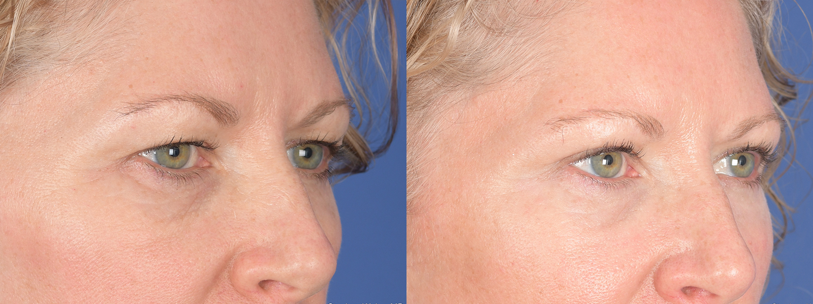 Blepharoplasty Before and After | Weber Facial Plastic Surgery