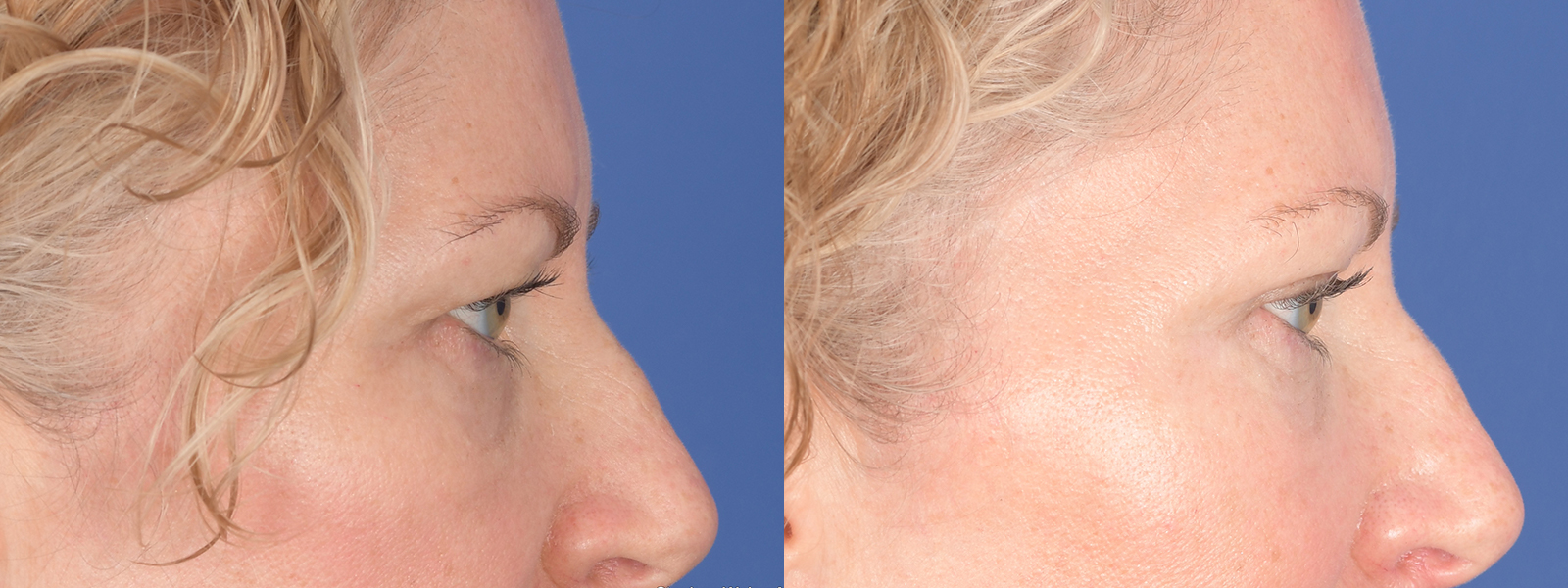 Blepharoplasty Before and After | Weber Facial Plastic Surgery