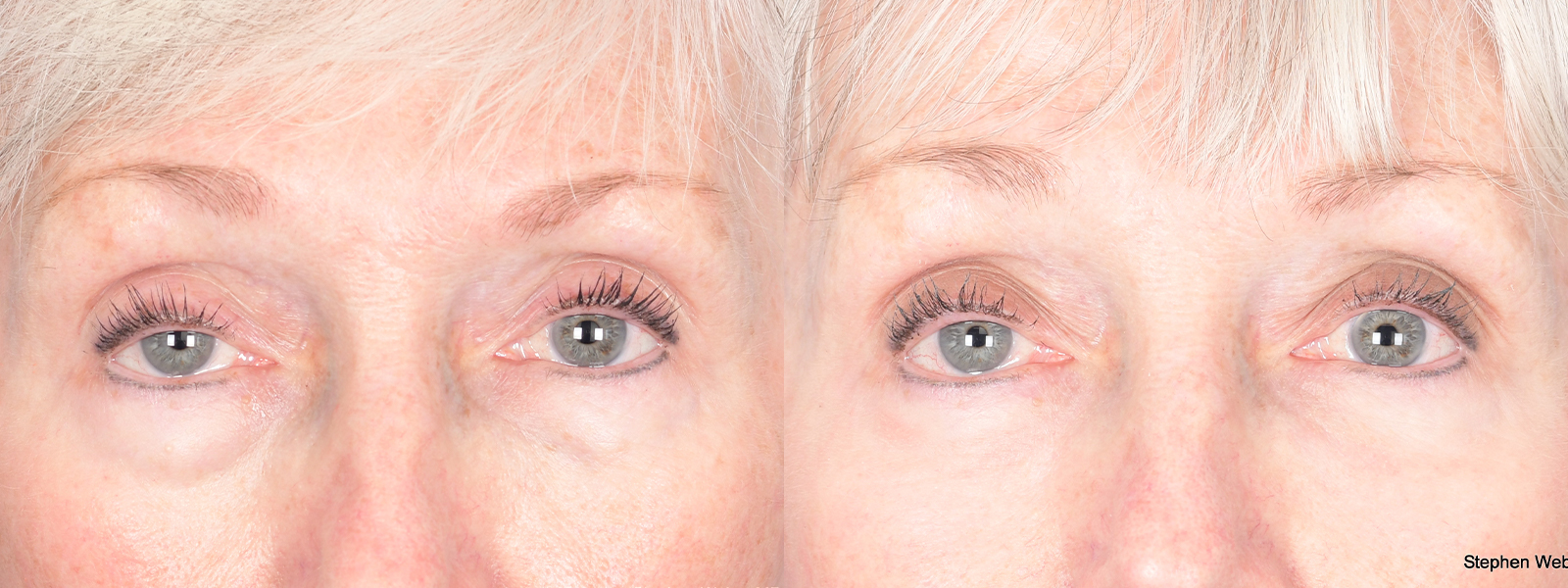 Blepharoplasty Before and After | Weber Facial Plastic Surgery