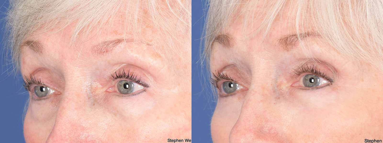 Blepharoplasty Before and After | Weber Facial Plastic Surgery