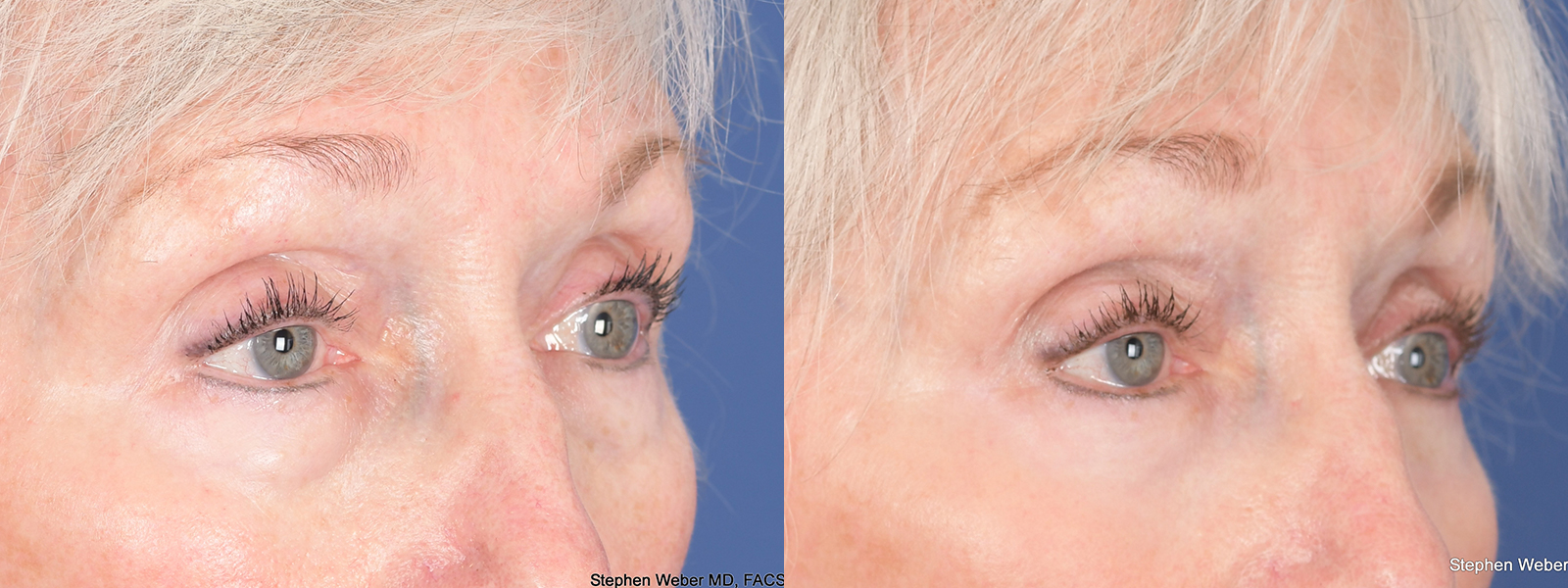 Blepharoplasty Before and After | Weber Facial Plastic Surgery