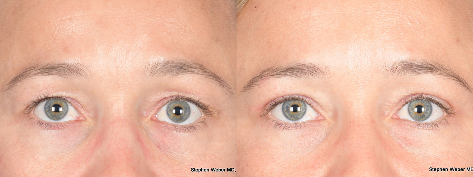 Blepharoplasty Before and After | Weber Facial Plastic Surgery