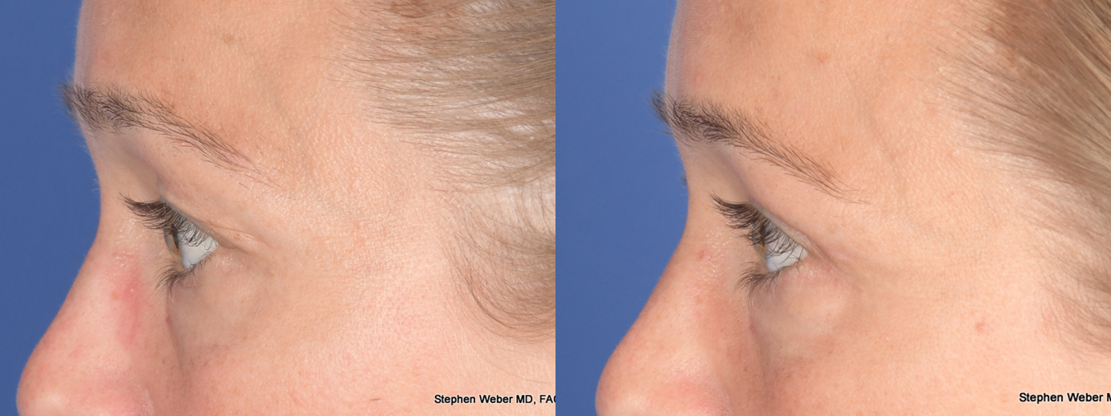 Blepharoplasty Before and After | Weber Facial Plastic Surgery