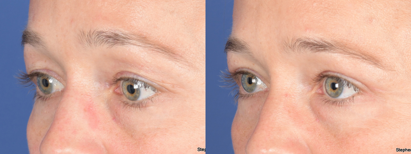 Blepharoplasty Before and After | Weber Facial Plastic Surgery