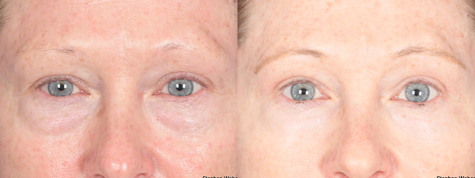 Blepharoplasty Before and After | Weber Facial Plastic Surgery