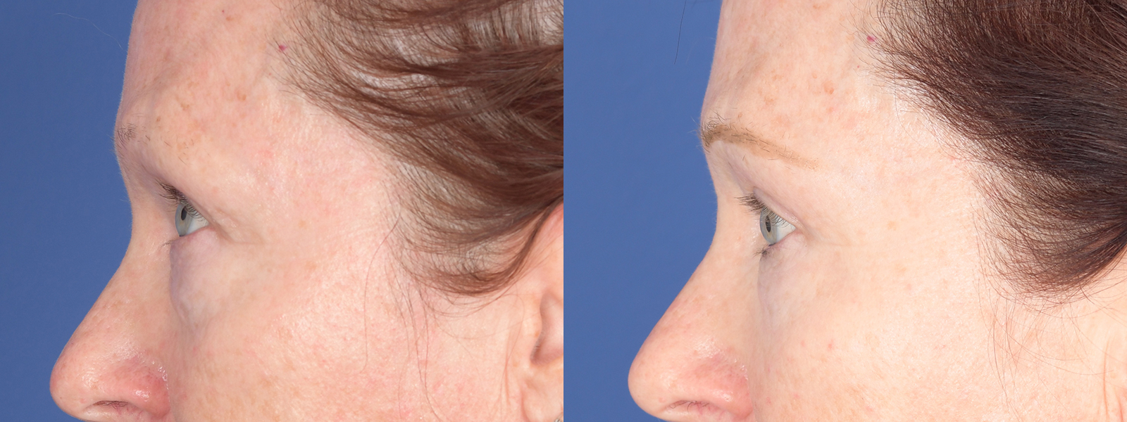 Blepharoplasty Before and After | Weber Facial Plastic Surgery