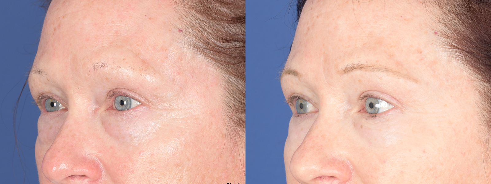 Blepharoplasty Before and After | Weber Facial Plastic Surgery