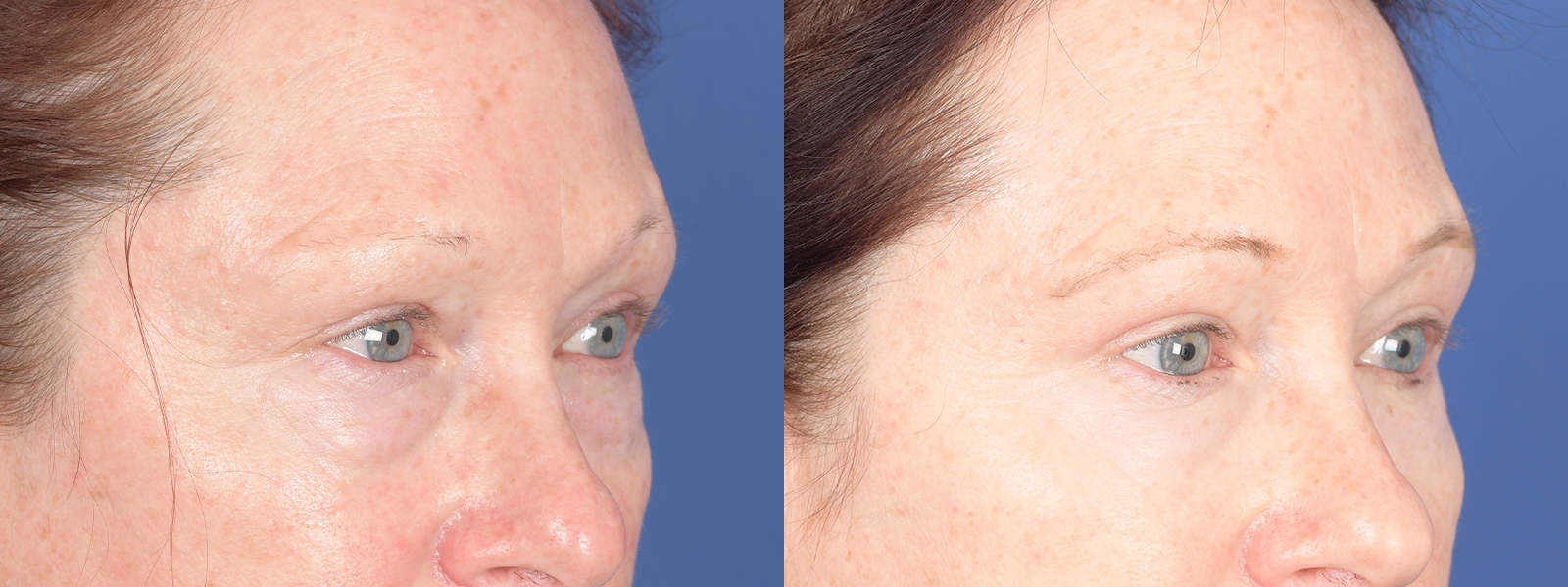 Blepharoplasty Before and After | Weber Facial Plastic Surgery