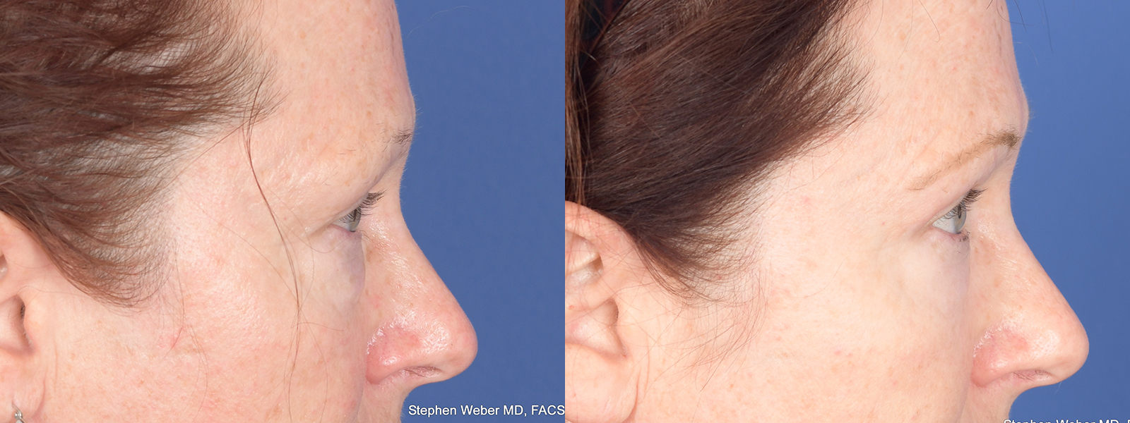 Blepharoplasty Before and After | Weber Facial Plastic Surgery