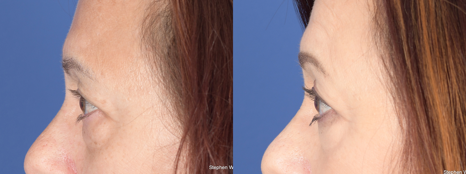 Blepharoplasty Before and After | Weber Facial Plastic Surgery
