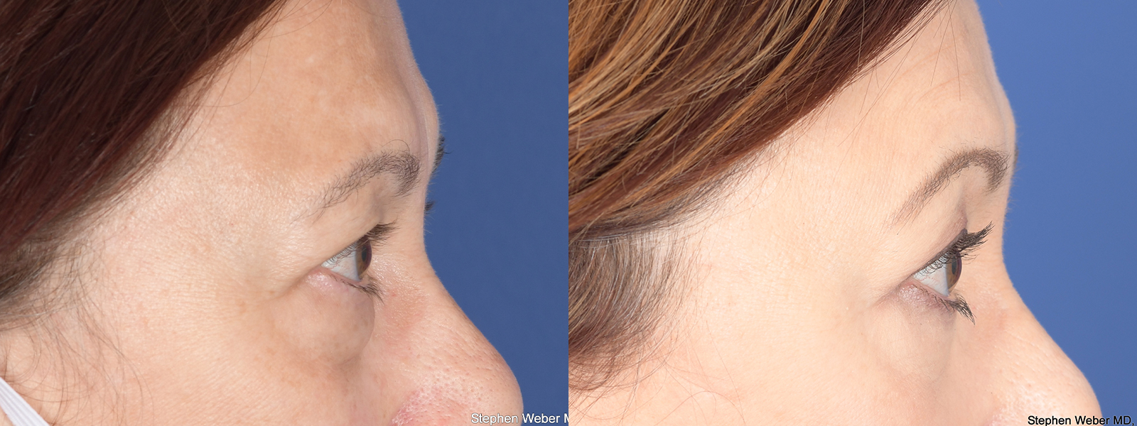 Blepharoplasty Before and After | Weber Facial Plastic Surgery