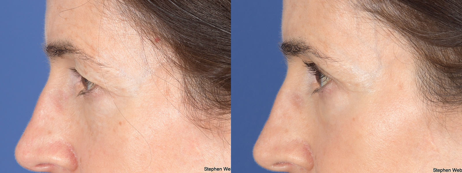 Blepharoplasty Before and After | Weber Facial Plastic Surgery