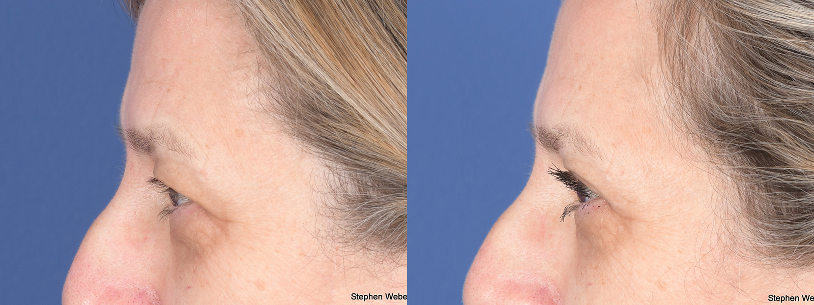 Blepharoplasty Before and After | Weber Facial Plastic Surgery