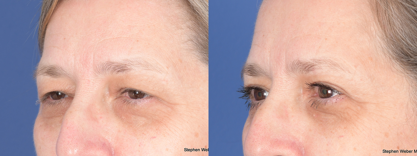 Blepharoplasty Before and After | Weber Facial Plastic Surgery