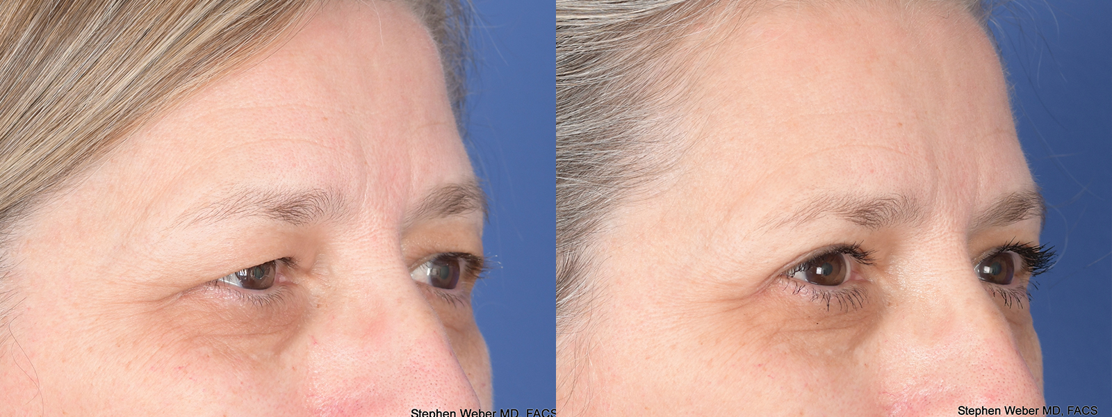 Blepharoplasty Before and After | Weber Facial Plastic Surgery