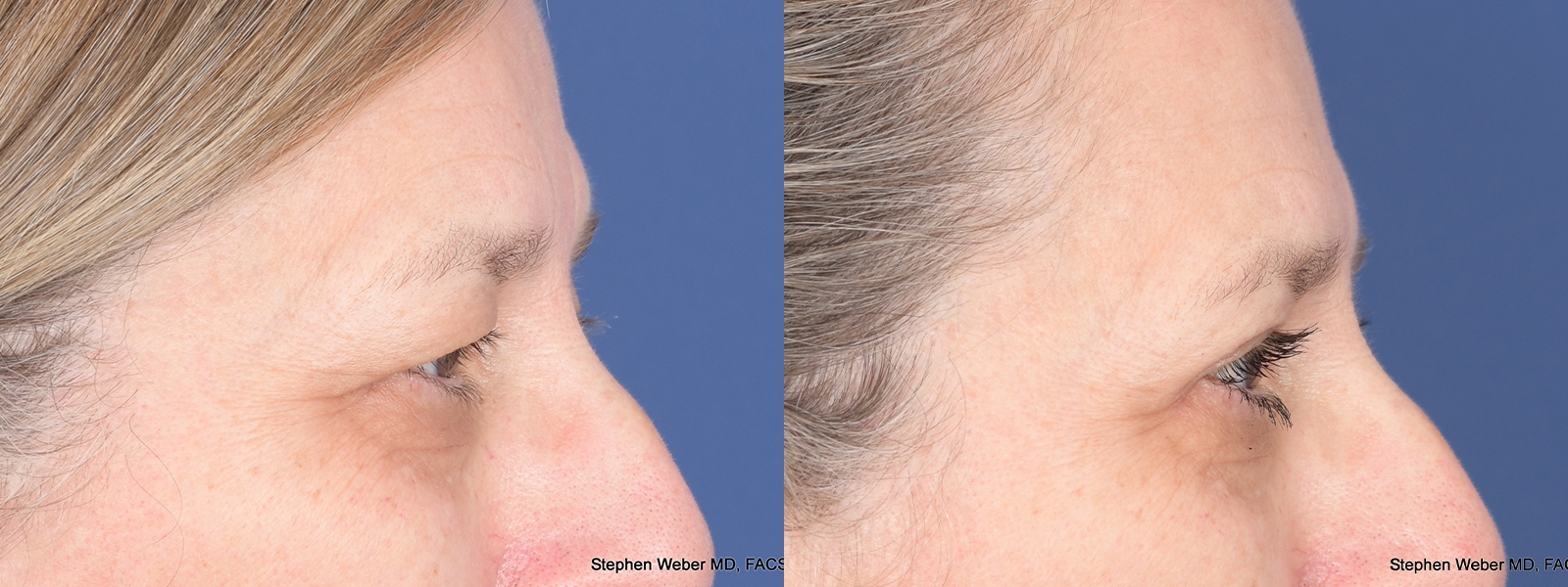 Blepharoplasty Before and After | Weber Facial Plastic Surgery