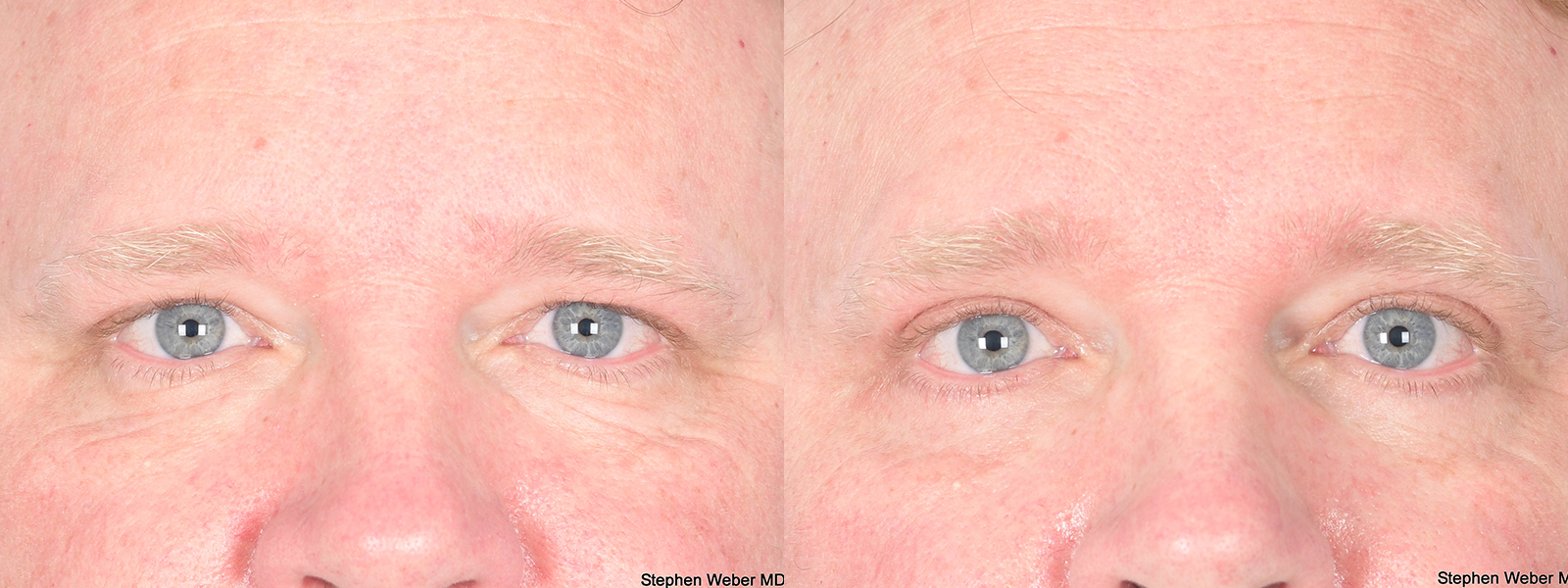 Blepharoplasty Before and After | Weber Facial Plastic Surgery