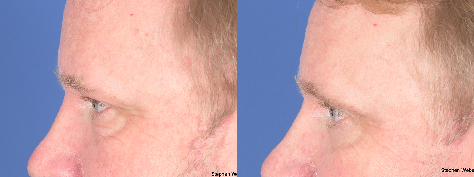 Blepharoplasty Before and After | Weber Facial Plastic Surgery