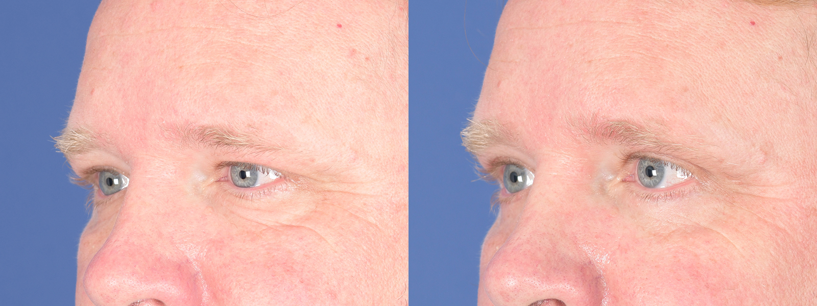 Blepharoplasty Before and After | Weber Facial Plastic Surgery