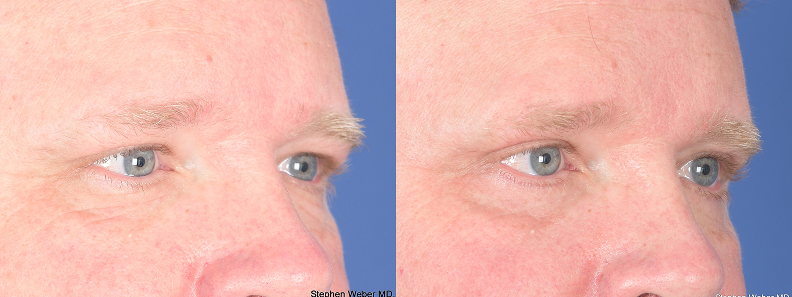 Blepharoplasty Before and After | Weber Facial Plastic Surgery