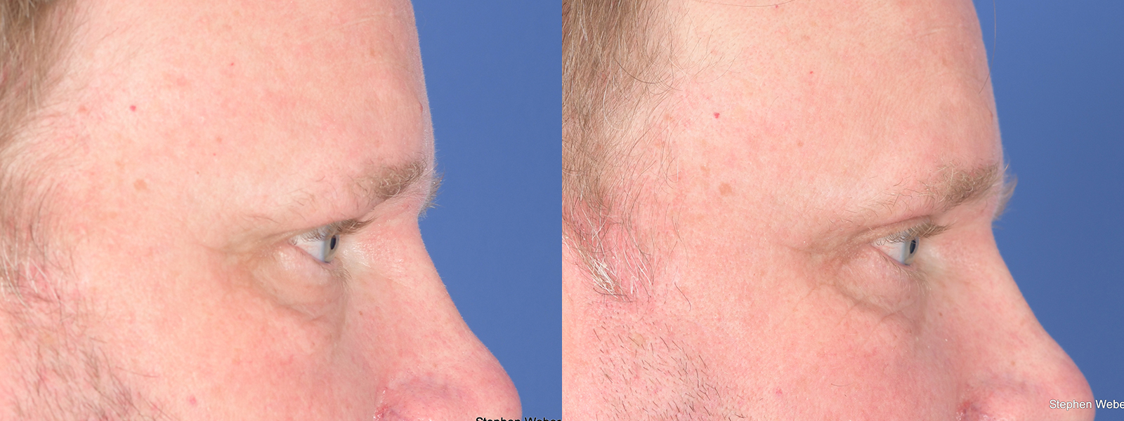 Blepharoplasty Before and After | Weber Facial Plastic Surgery