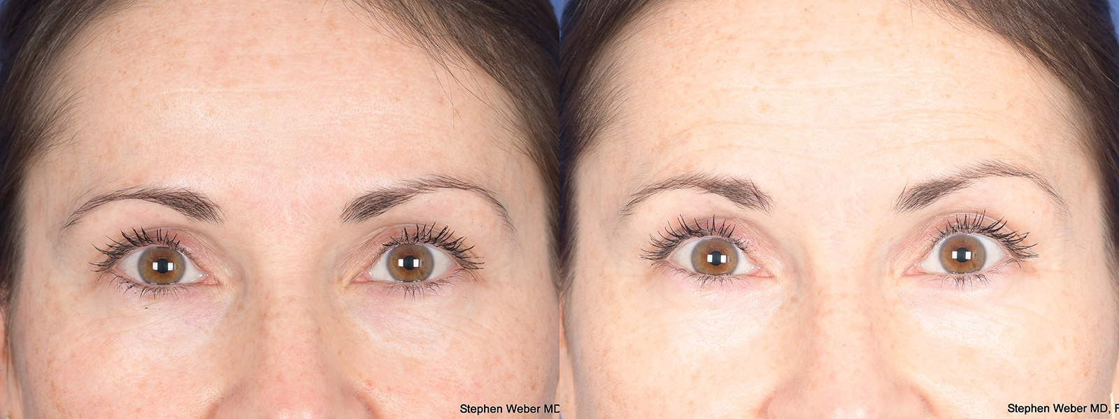 Blepharoplasty Before and After | Weber Facial Plastic Surgery