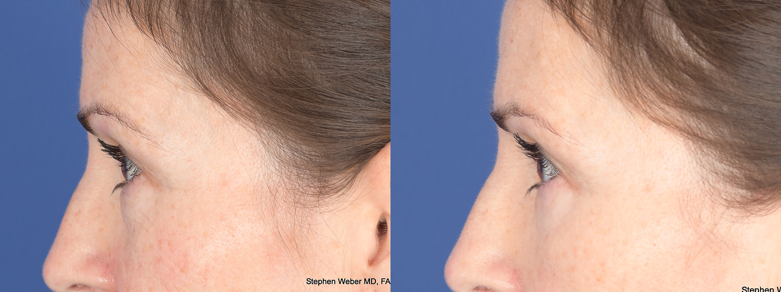 Blepharoplasty Before and After | Weber Facial Plastic Surgery
