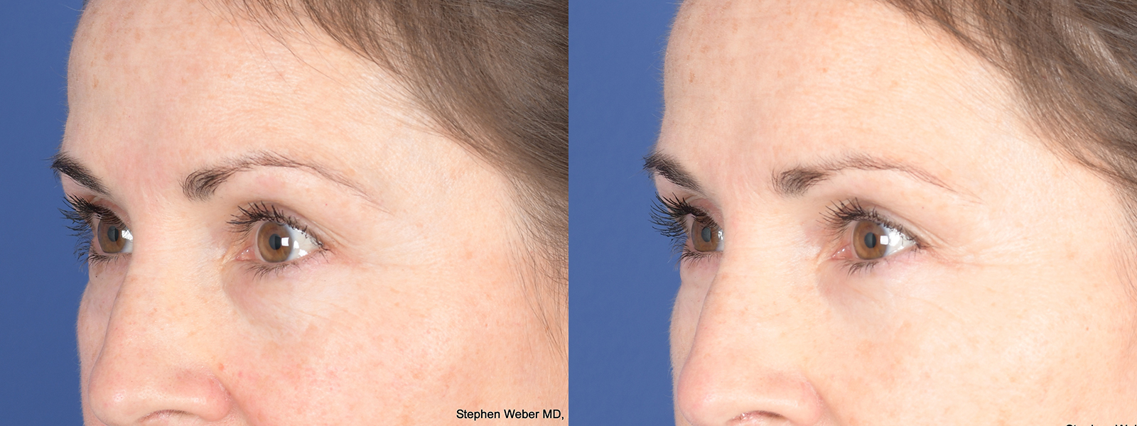 Blepharoplasty Before and After | Weber Facial Plastic Surgery