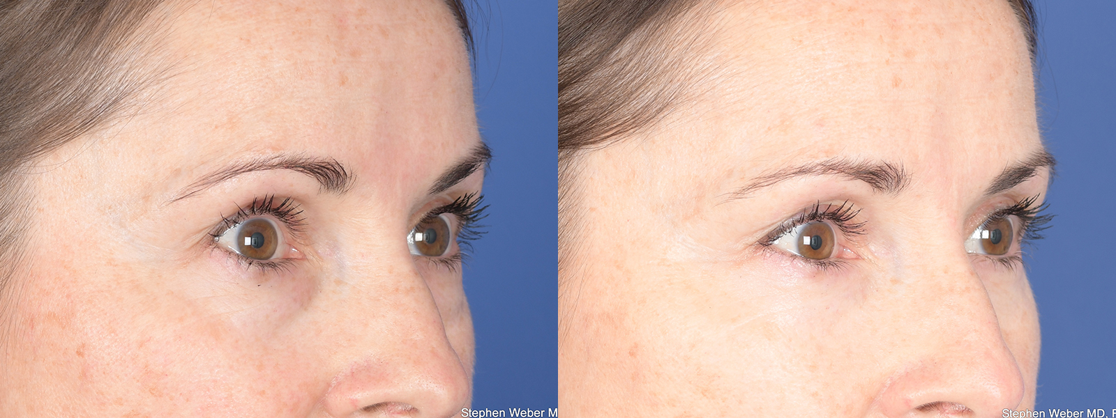 Blepharoplasty Before and After | Weber Facial Plastic Surgery