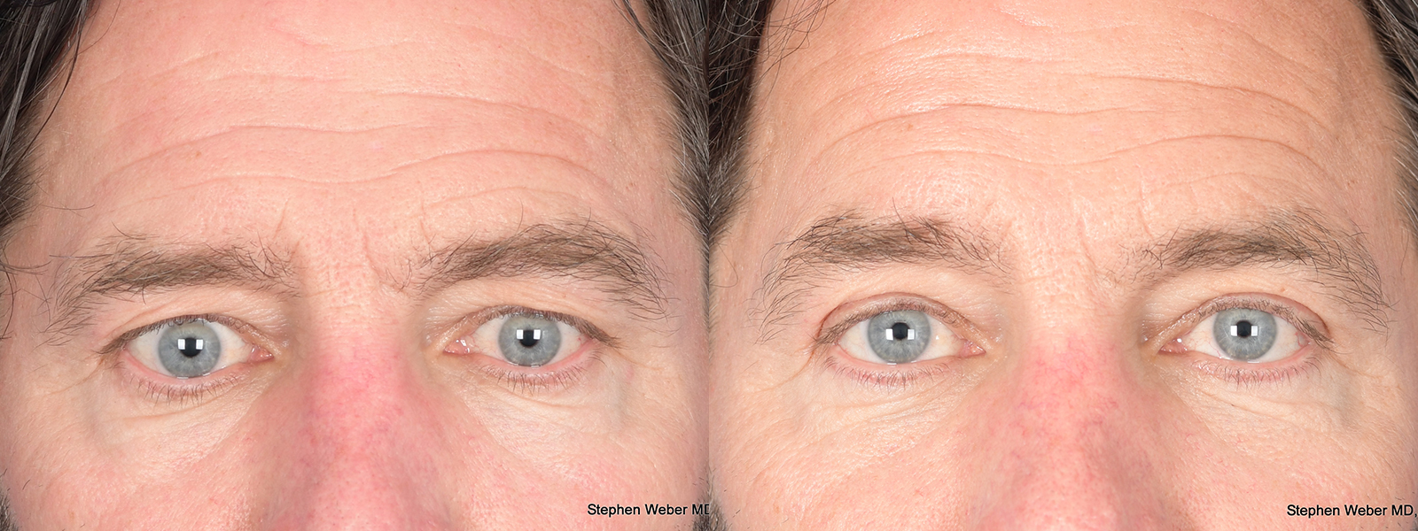 Blepharoplasty Before and After | Weber Facial Plastic Surgery